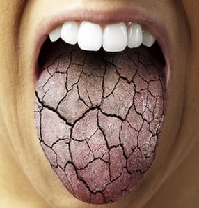 Waarom heb ik ‘S ochtends een droge mond?